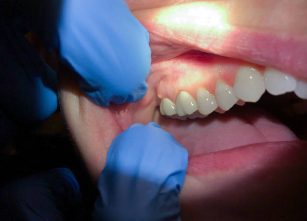 Best Emergency Treatment for Dental Infections or Abscesses in Reese, MI
